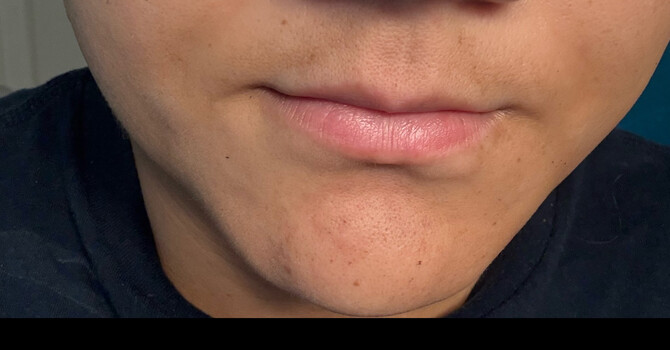 Understanding the Consequences of Melasma and Keratosis image