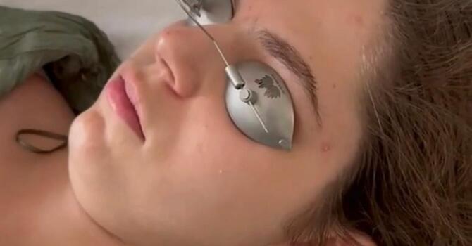 Acne Treatment & Acne Scar Correction